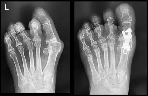 Hallux Rigidus (Stiff Big Toe) | Symptoms, Causes & Treatment - Pure ...