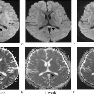 Brain magnetic resonance imaging (MRI) changes of the lesion in the... | Download Scientific Diagram