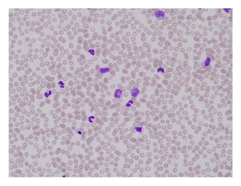 Peripheral blood film showing left shift and monocytes. | Download Scientific Diagram