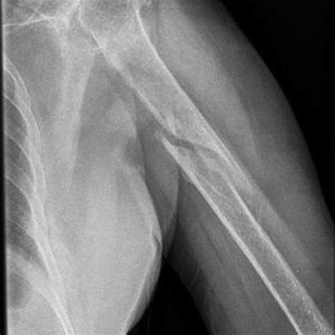 (PDF) Midshaft humeral fracture following a proximal humeral fracture ...