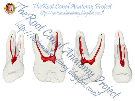 The Root Canal Anatomy Project: Maxillary First Molar