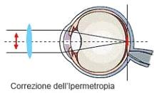 Hypermetropia: causes and symptoms