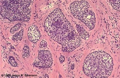 Histology-Nodular Basal Cell Carcinoma (high power)