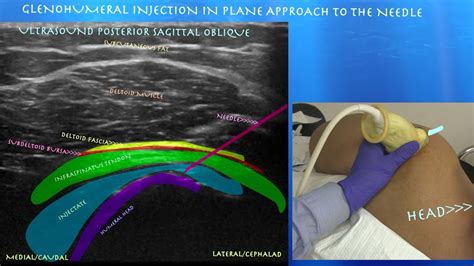 Ultrasound Guided Glenohumeral Injection