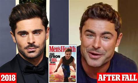 Zac Efron Plastic Surgery Before and After: Jaw-Dropping Transformations