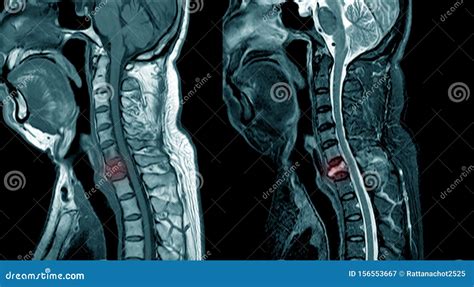 MRI of Cervical Spine Spine Soft Tissue Mass. Stock Image - Image of ...