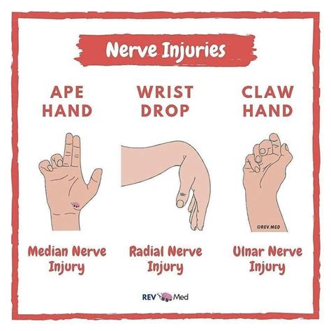 Read More and Download Book immediately #repost @medical.graph Median Nerve Ape Hand Compression ...