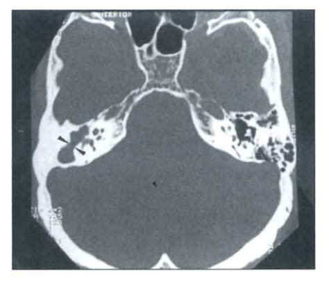 Prussak Space Ct Scan