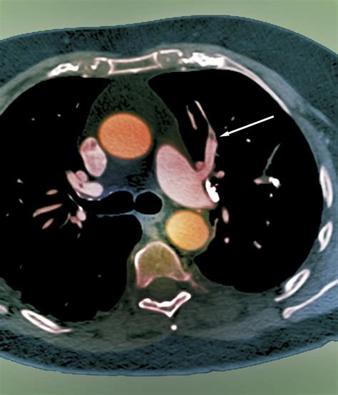 Pulmonary Embolism, Ct Scan Photograph by Zephyr - Pixels