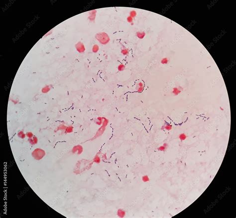 Smear of human blood culture Gram's stained with gram positive cocci in ...