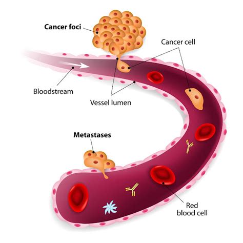 Cancer De Seno Con Metastasis