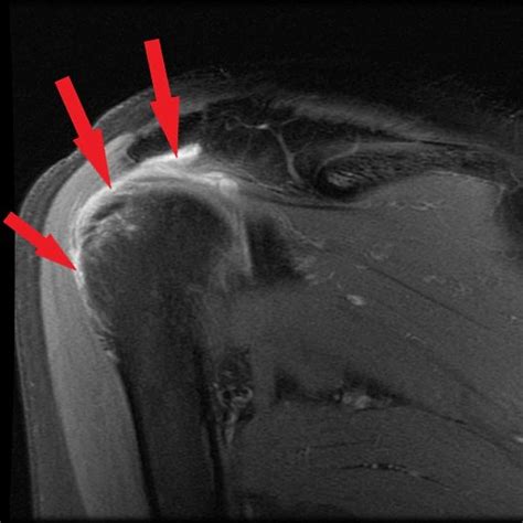 Subacromial Subdeltoid Bursitis Mri