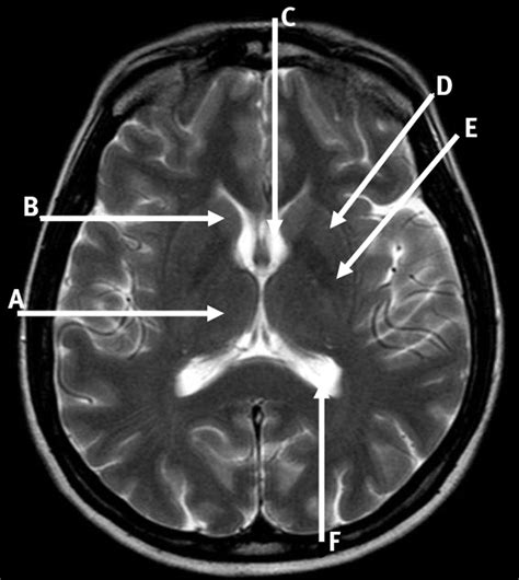 Axial Brain Anatomy