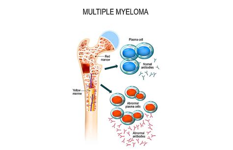 Multiple Myeloma | Types, Causes, Symptoms, Diagnosis & Treatment - Healthella