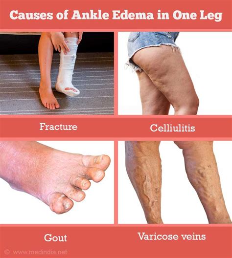 Ankle Edema / Ankle Swelling - Causes FAQs