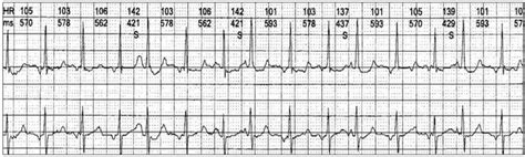 The Wandering Atrial Pacemaker - Resources