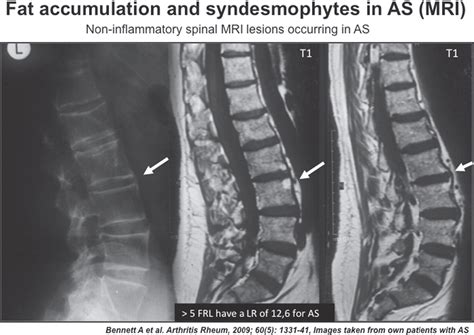 Imaging of axial spondyloarthritis including ankylosing spondylitis | Annals of the Rheumatic ...