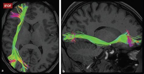 Uncinate Fasciculus - Diffusion weighted and diffusion tensor imaging: a clinical guide