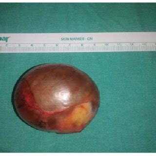 Postoperative view of an ovarian dermoid cyst. | Download Scientific Diagram