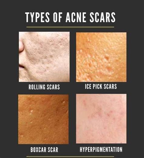 What Causes Acne Scars? - Acne Scars Treatment