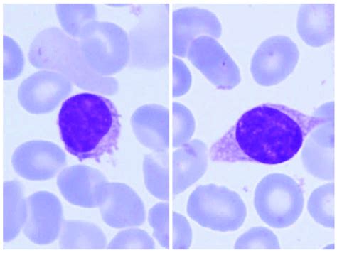 Splenic diffuse red pulp small B-cell lymphoma: revision of a series of ...