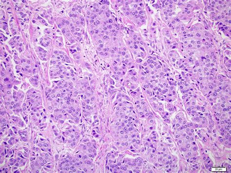 Invasive Urothelial Carcinoma