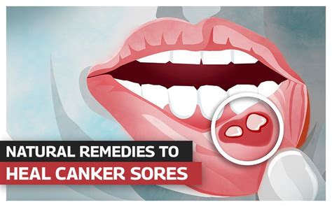 How To Fight Canker Sores - Shopfear0