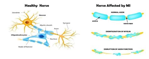 Multiple Sclerosis - San Diego Biomedical Research InstituteSan Diego Biomedical Research Institute