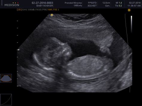 Gender reveal ultrasound 16 weeks | BabyCenter