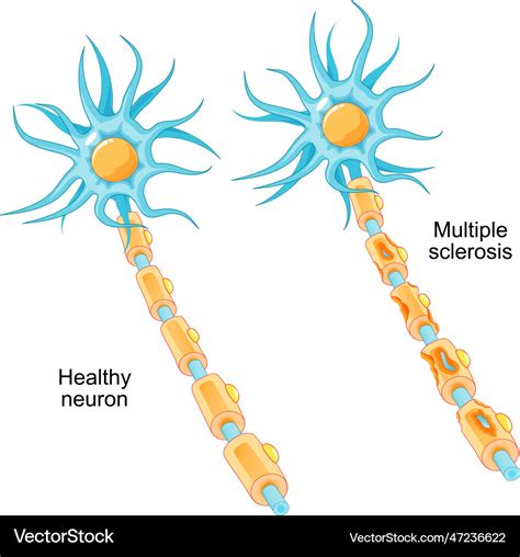 Multiple sclerosis autoimmune disease Royalty Free Vector