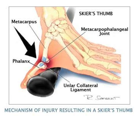 MRI NEWSLETTER: Ulnar Collateral Ligament Injury - Radius Imaging Ligament Tear, Ligament Injury ...