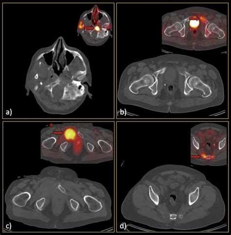 Can Low-Dose CT Have an Impact in Diagnosing Bone Metastasis in Patients with Prostate Cancer?