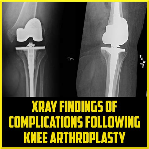 Total Knee Arthroplasty Indications And Complications - vrogue.co