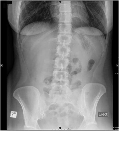 Abdominal x ray