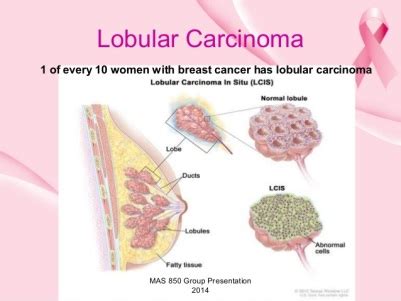 Lobular carcinoma in situ | Russian Federation| PDF | PPT| Case Reports ...