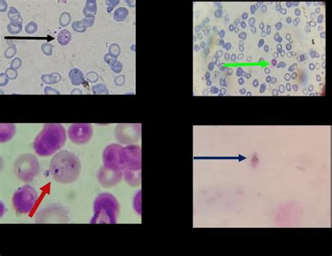 Identification of Plasmodium falciparum under microscope | Download ...