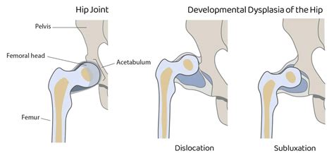 Hip Subluxation - Type, Cause, Symptoms, Treatment - Samarpan