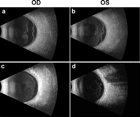 Ultrasound examination during and after treatment. a, b Bilateral... | Download Scientific Diagram