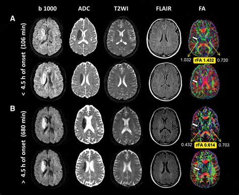 Increased Corticospinal Tract Fractional Anisotropy Can Discriminate Stroke Onset Within the ...