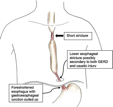 A) Patient 1-visual representation of the two esophageal strictures. B)... | Download Scientific ...