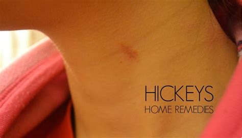 Overnight Remedy on How to Get Rid Of a Hickey with Peppermint ...