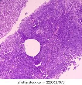 Supraclavicular Lymph Node Biopsy Microscopic Image Stock Photo 2200617073 | Shutterstock