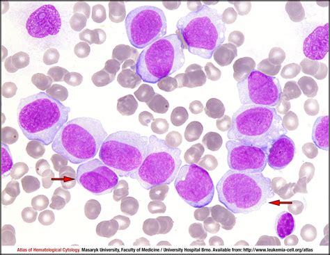 Acute monoblastic/monocytic leukaemia - CELL - Atlas of Haematological Cytology