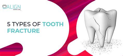 5 types of tooth fracture