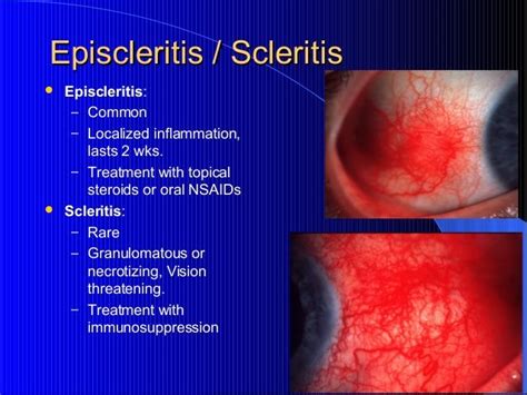 32 best Scleritis images on Pinterest