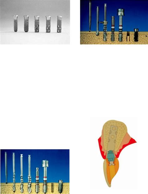 15. The ITI Dental Implant System