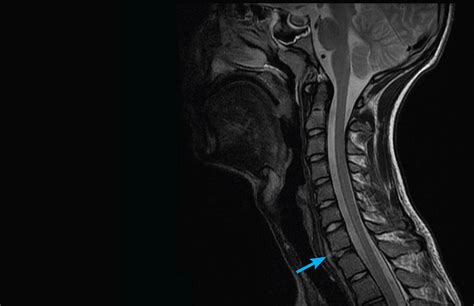 mri-scan-spine-melbourne-radiology-clinic-2 - MRI at Melbourne Radiology Clinic