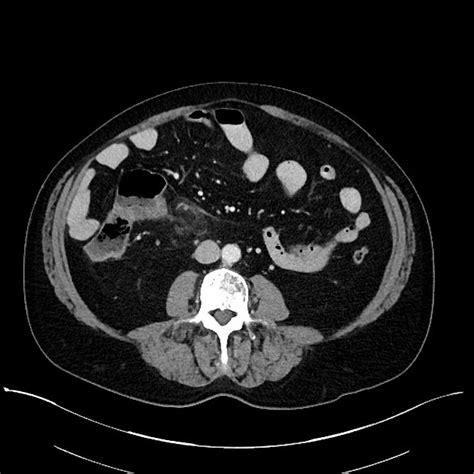 Radiopaedia Appendicitis Alternative nonsurgical diagnoses at sonography and ct