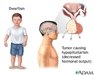 Dwarfism, pituitary. Causes, symptoms, treatment Dwarfism, pituitary