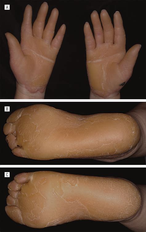 Epidermolytic Palmoplantar Keratoderma With Constriction Bands on Bilateral Fifth Toes ...